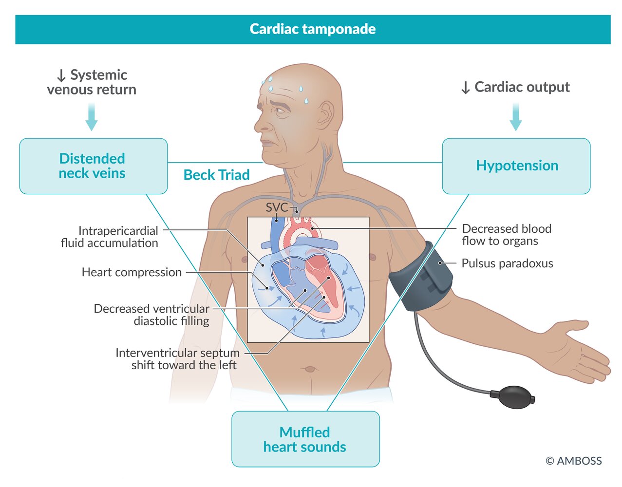 Cardiac tamponade