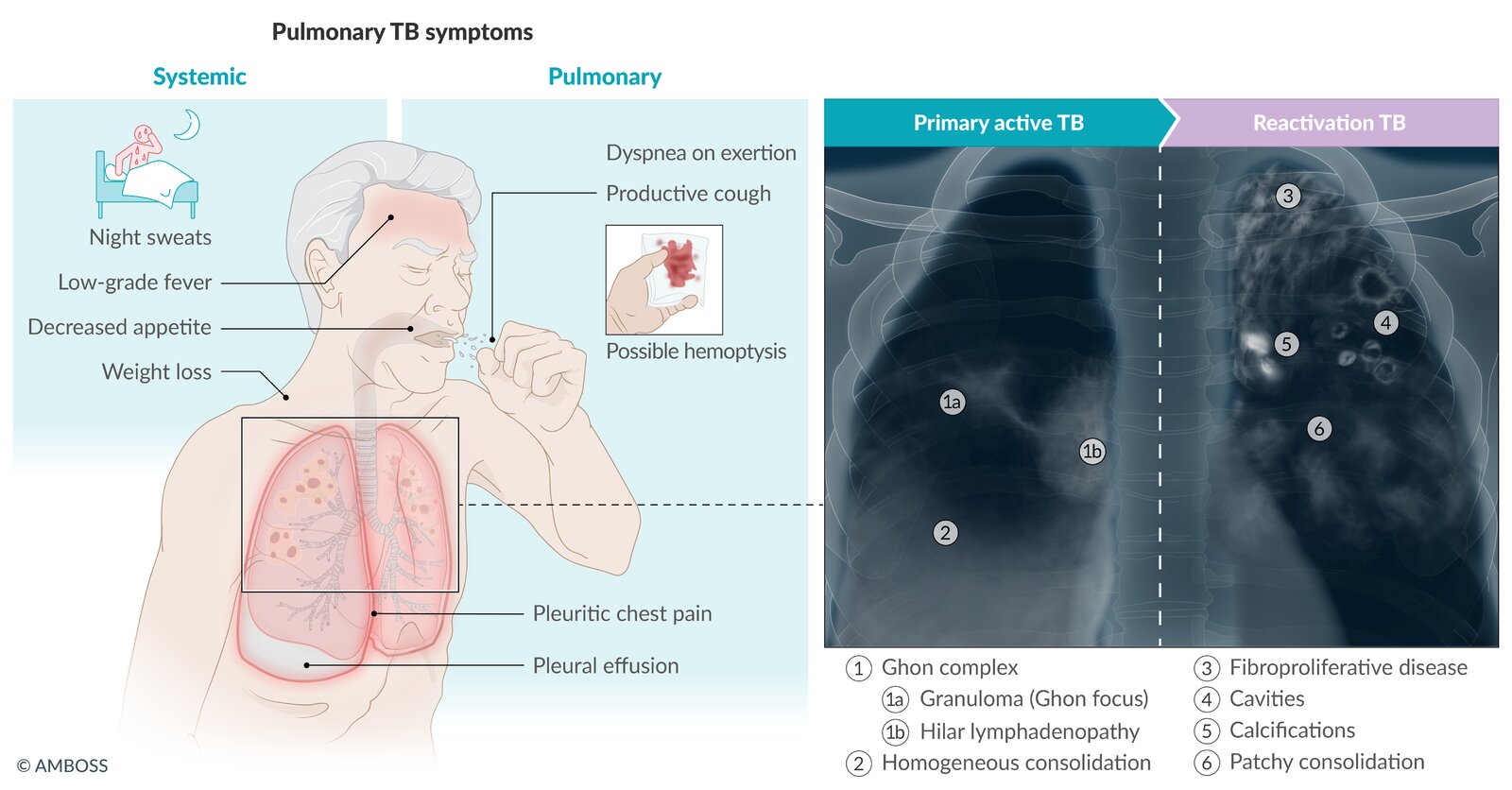 Pulmonary tuberculosis