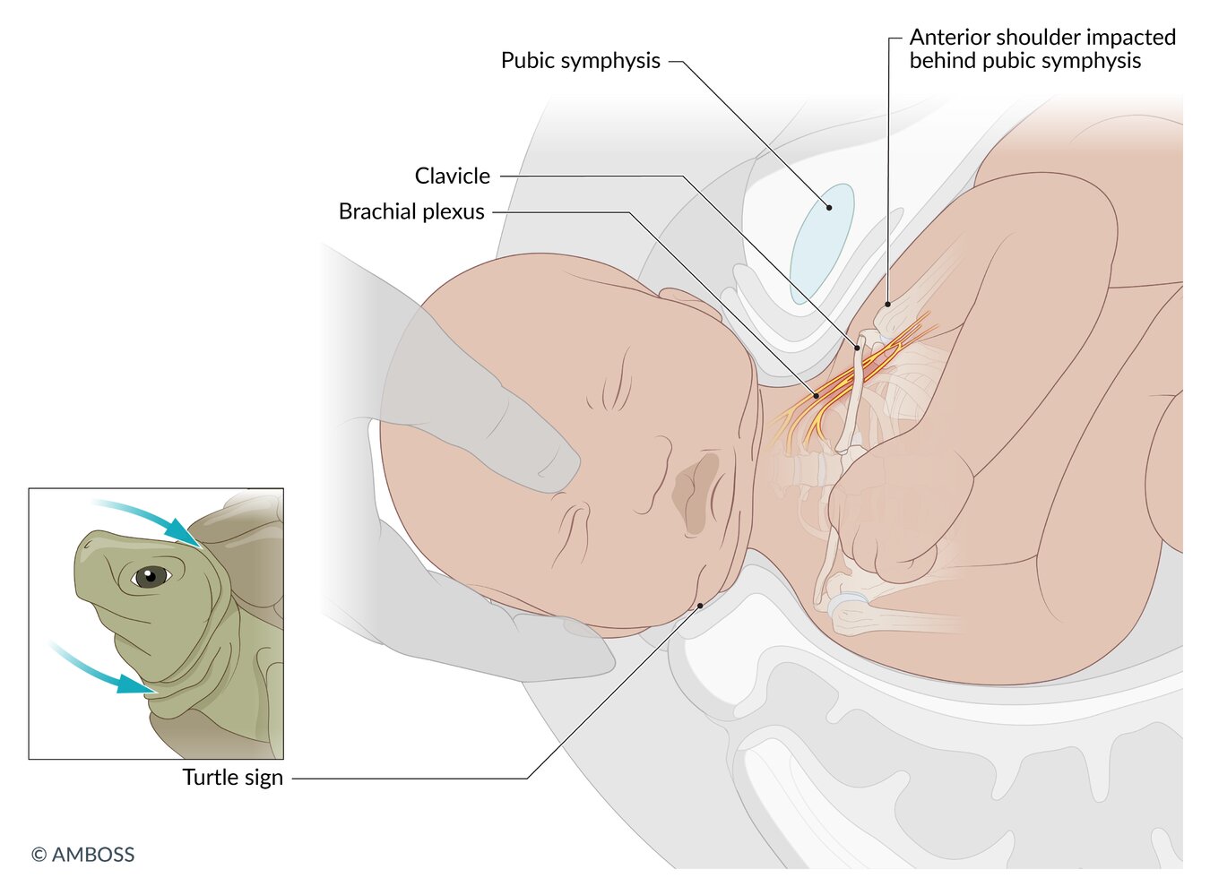 Shoulder dystocia