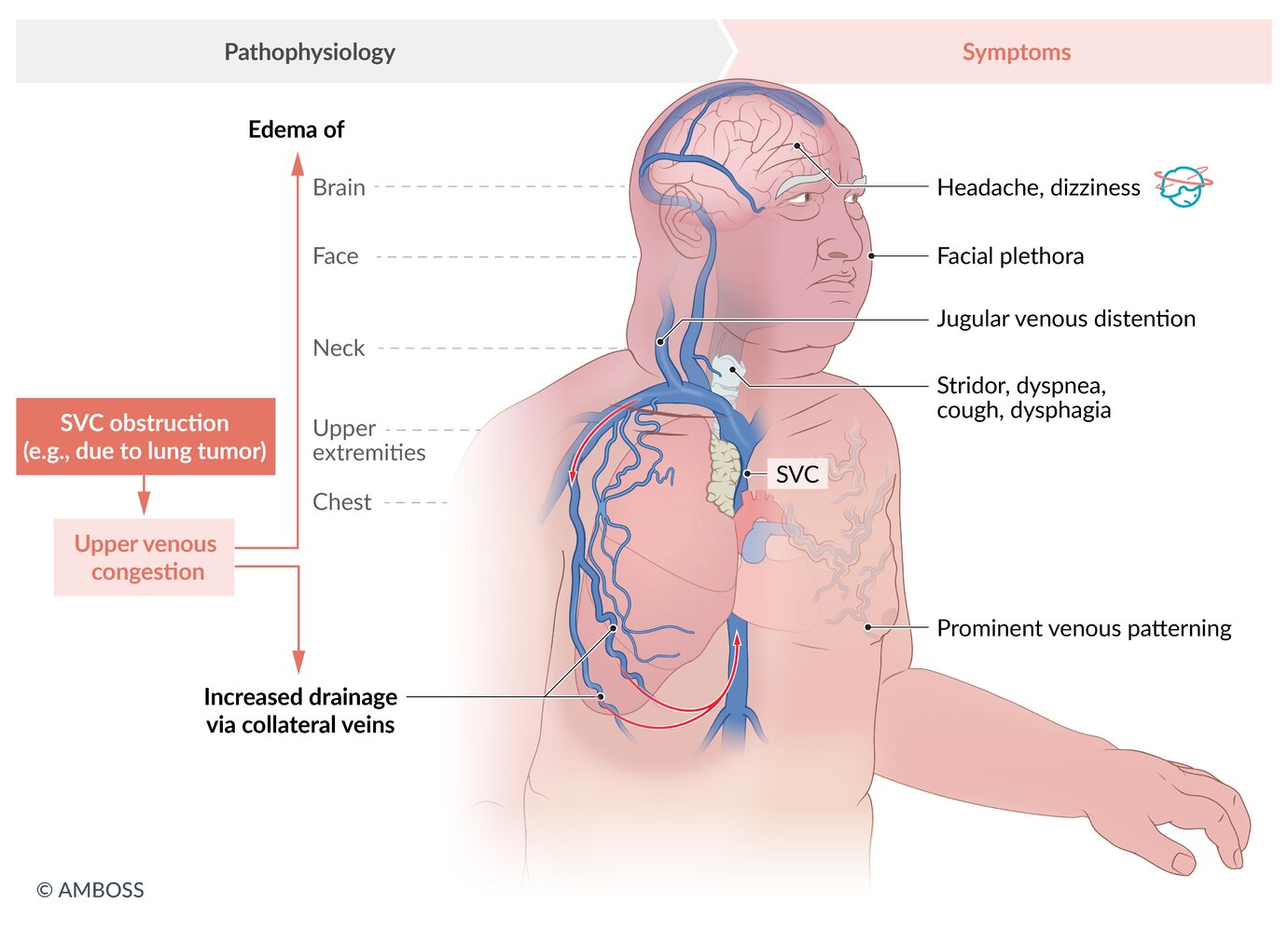 Superior vena cava syndrome