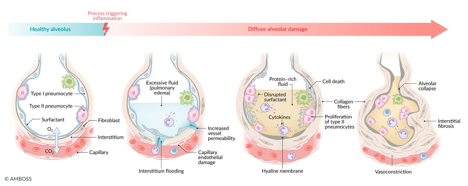 Pathophysiology of acute respiratory distress syndrome (ARDS)
