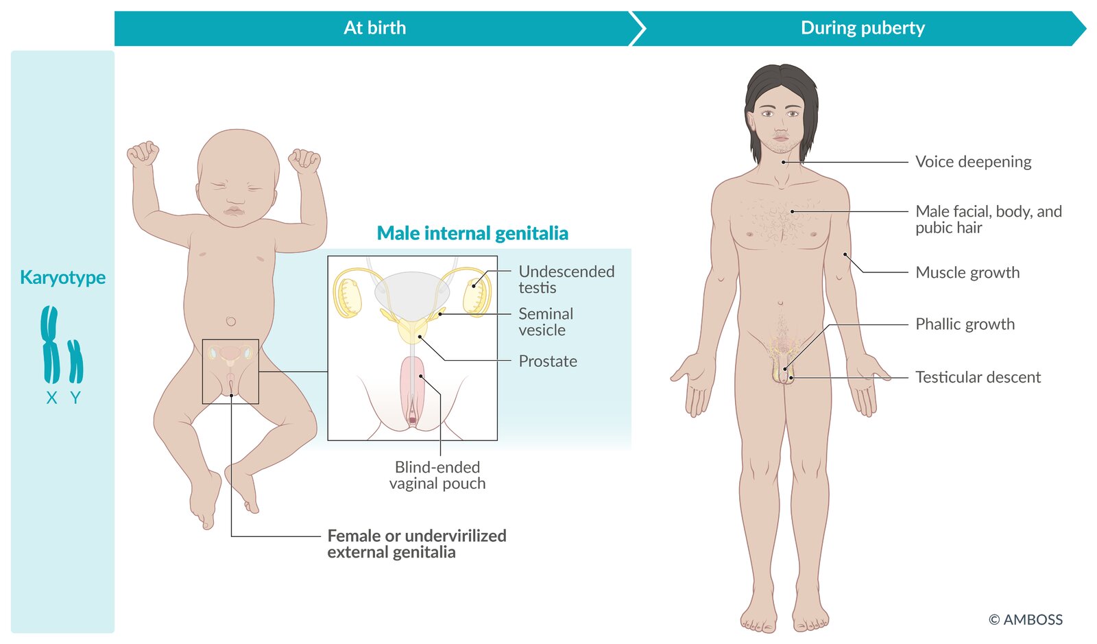 5-Alpha-reductase deficiency