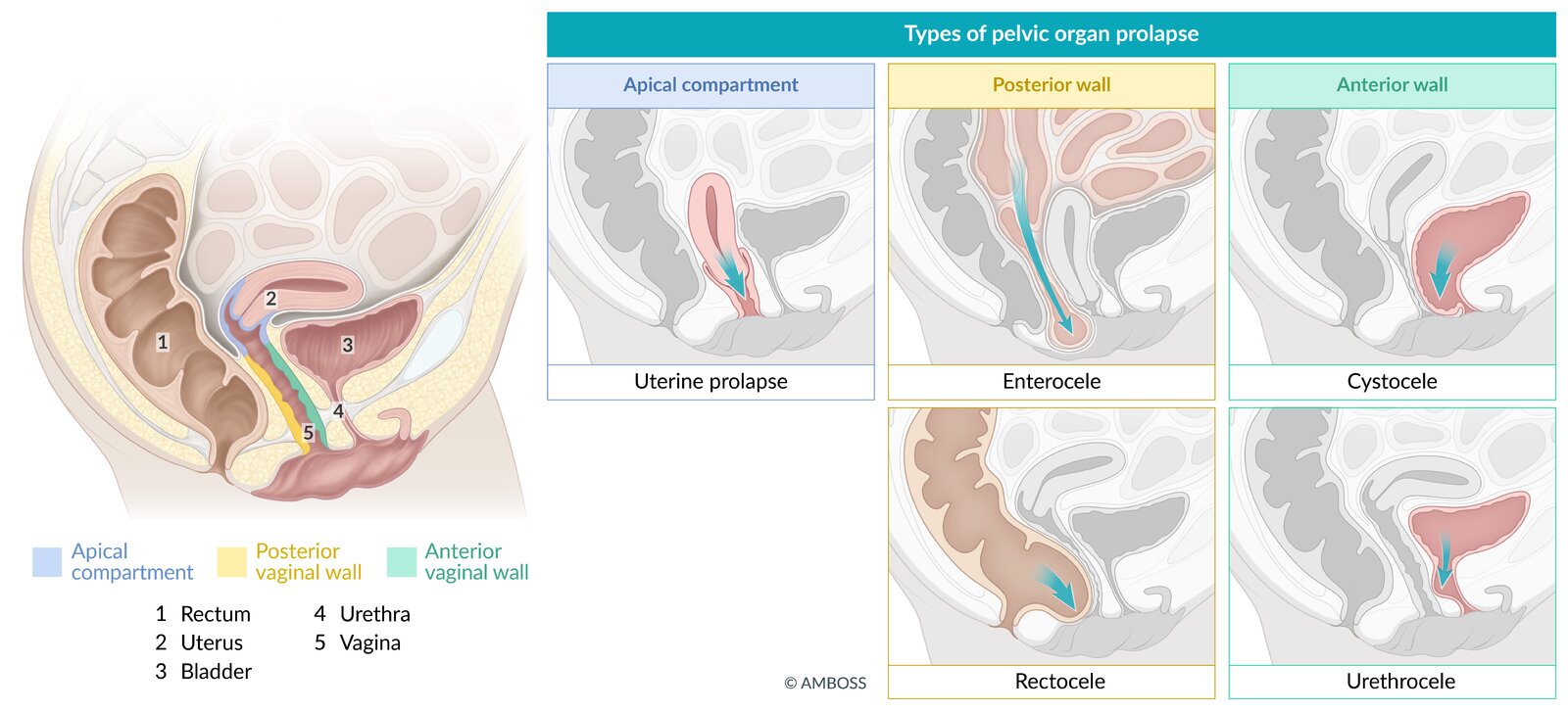 Types of pelvic organ prolapse