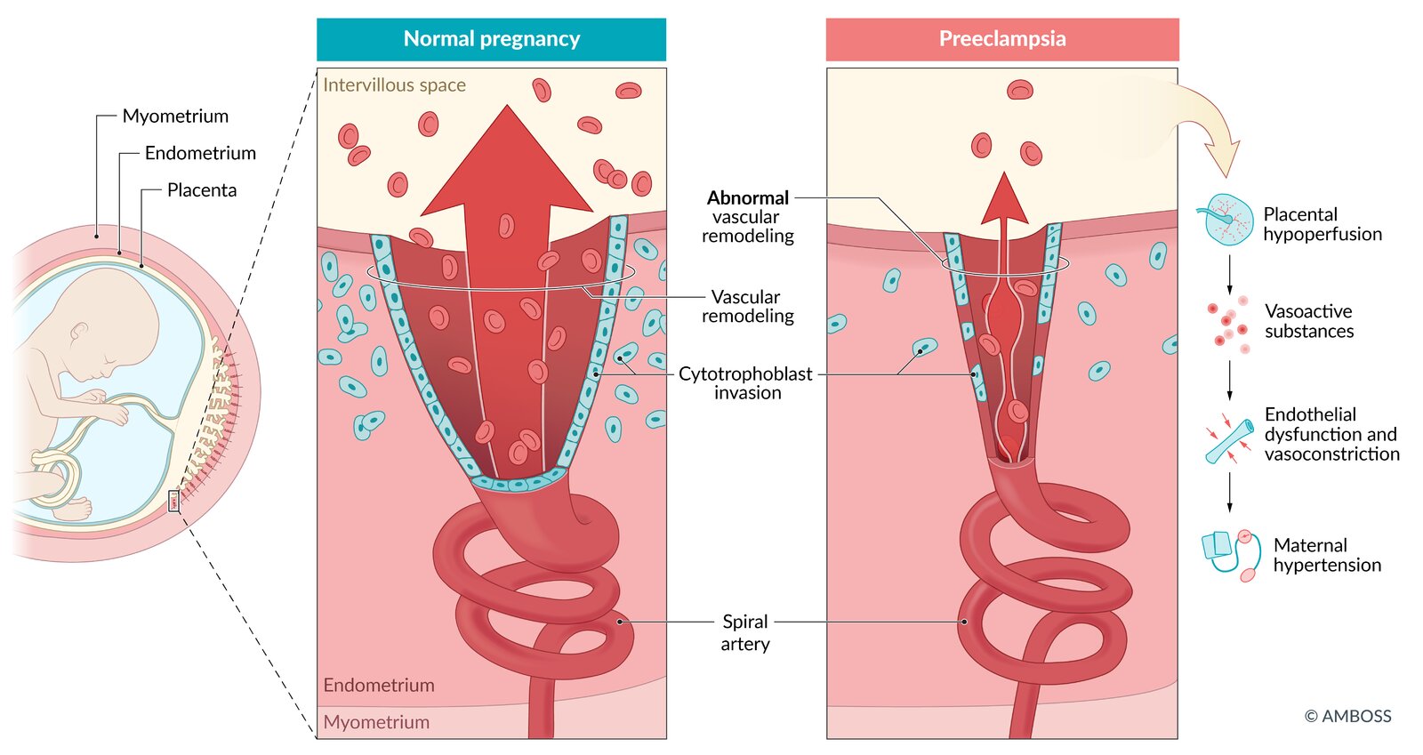 Pathophysiology of preeclampsia