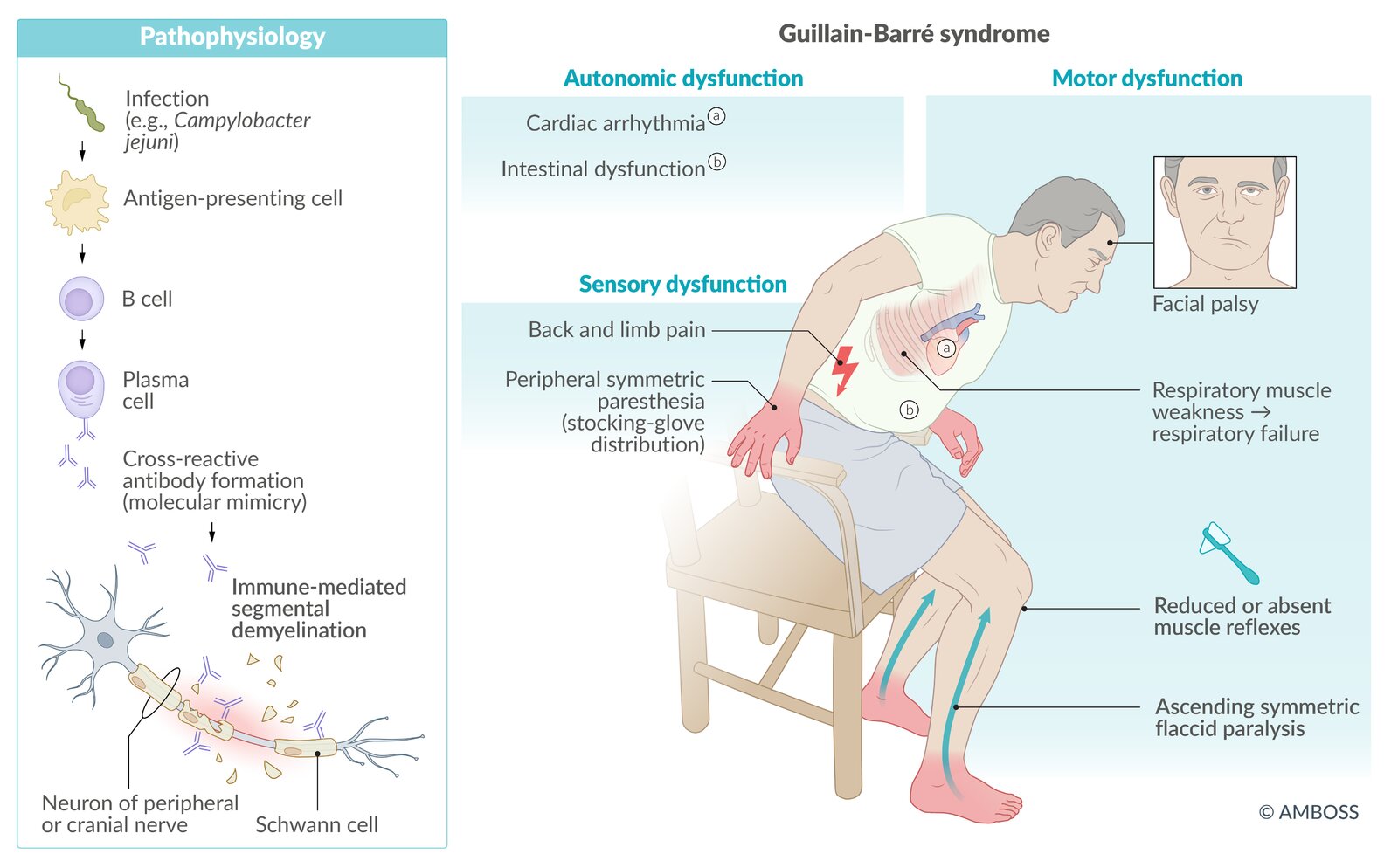 Guillain-Barré syndrome