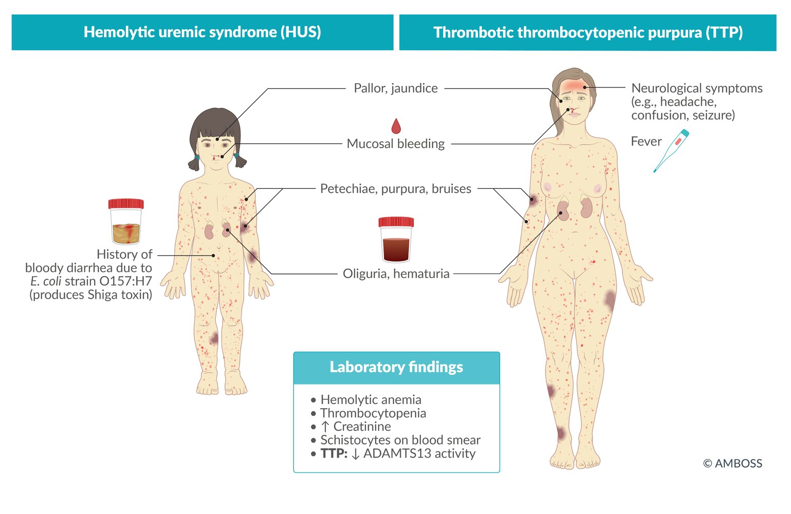 Hemolytic uremic syndrome and thrombotic thrombocytopenic purpura