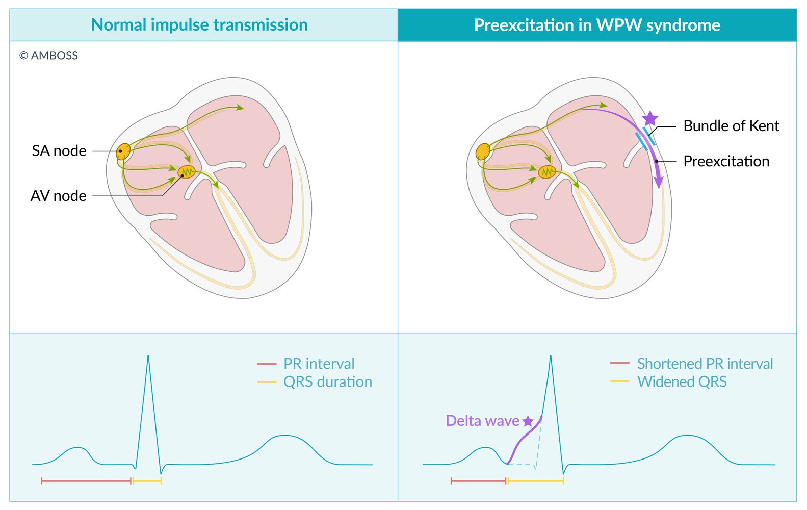 Wolff-Parkinson-White (WPW) syndrome and pattern