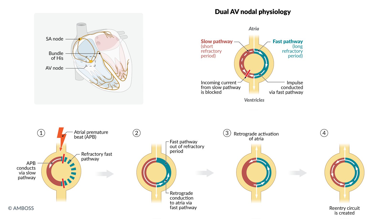 Pathophysiology of typical atrioventricular nodal reentrant tachycardia (AVNRT)