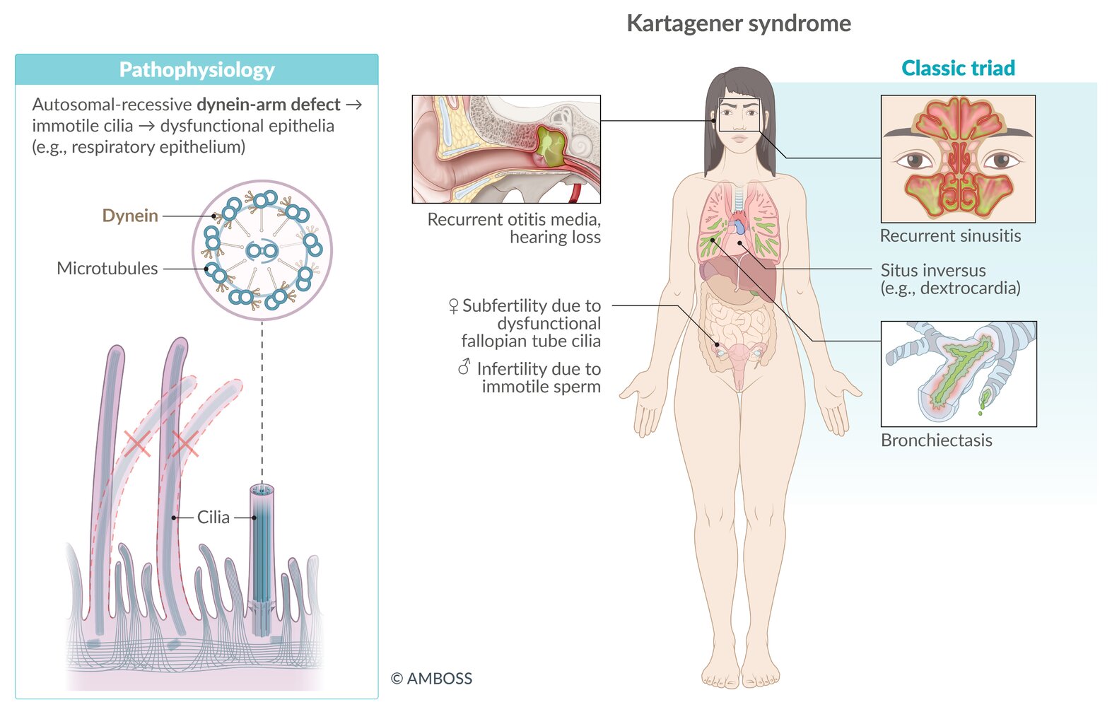 Kartagener syndrome