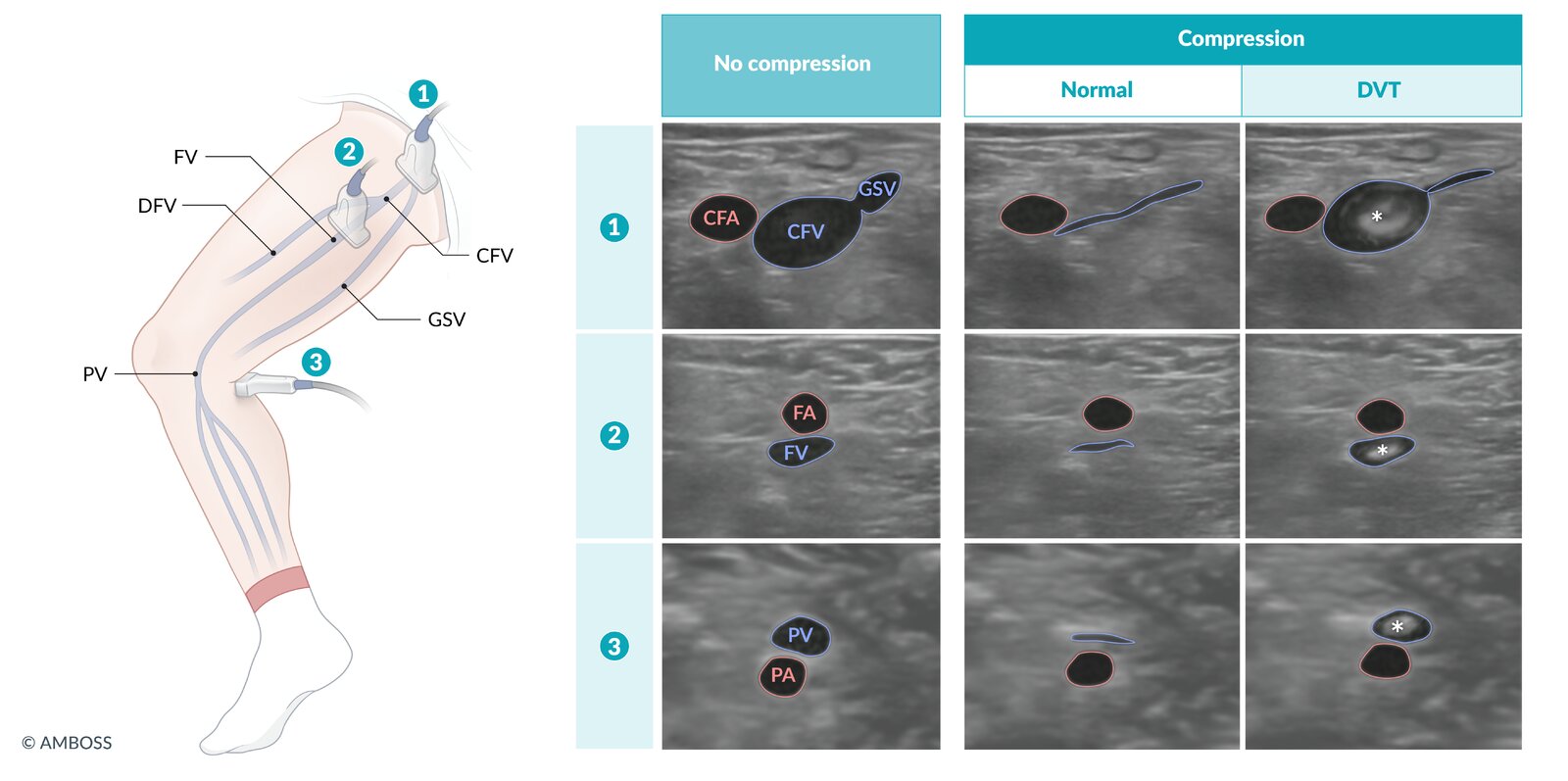 POCUS protocol for detection of lower extremity DVT