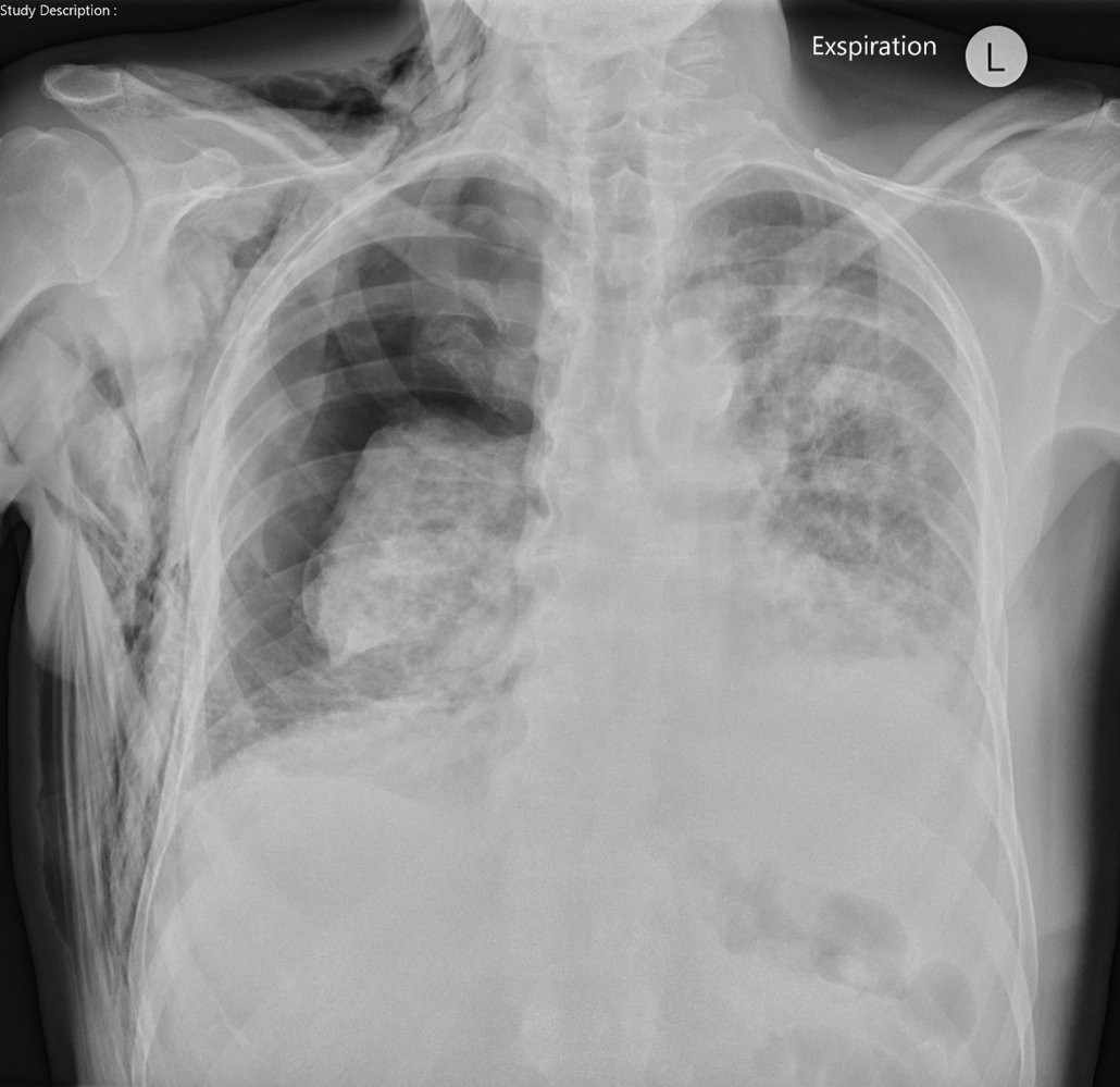 Pneumothorax and subcutaneous emphysema