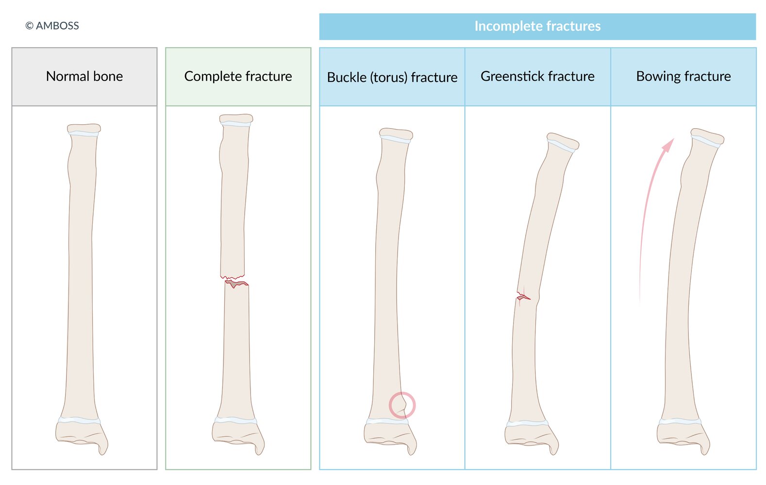 Complete vs. incomplete fractures
