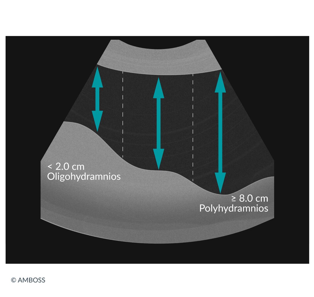 Evaluation of amniotic fluid volume