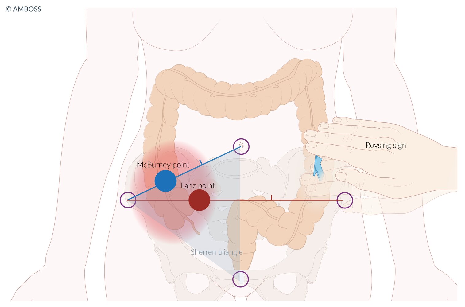Signs of appendicitis