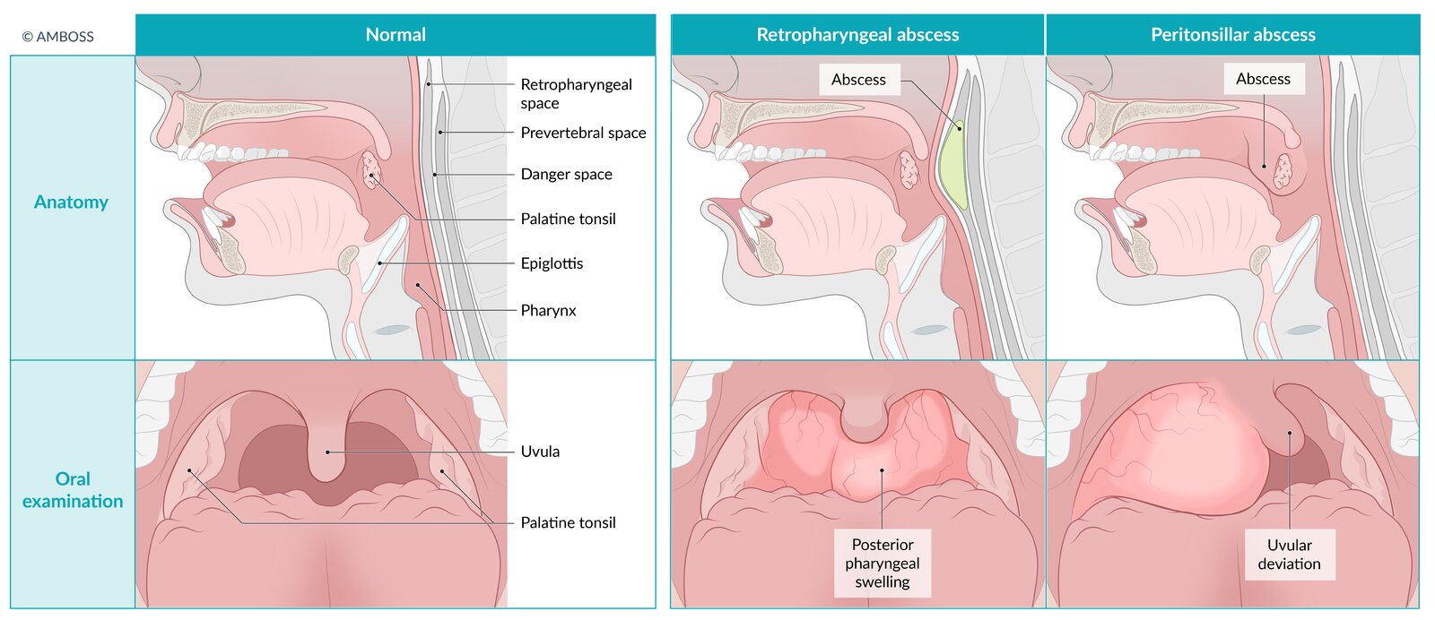Retropharyngeal abscess and peritonsillar abscess