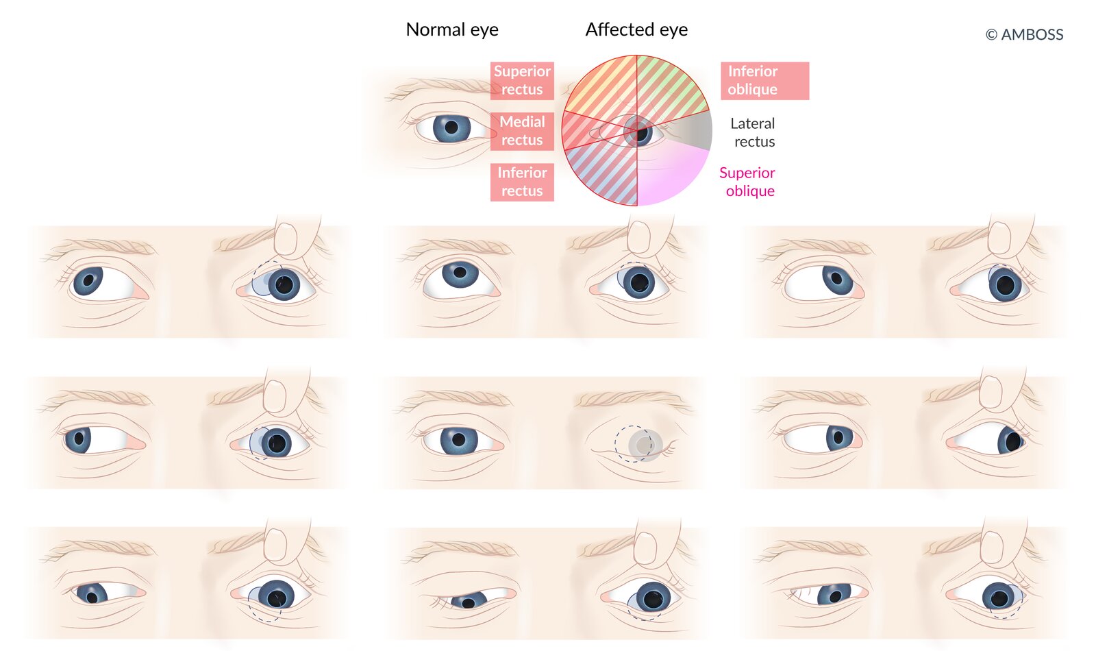 Oculomotor nerve palsy