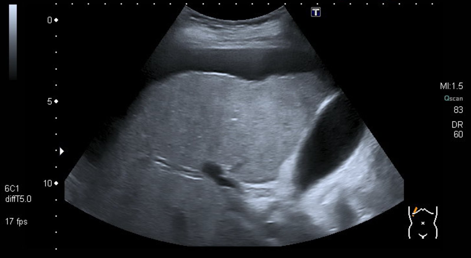 Decompensated hepatic cirrhosis