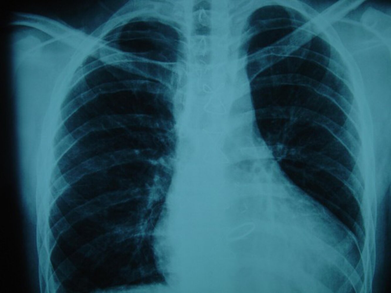 Rib notching in coarctation of the aorta