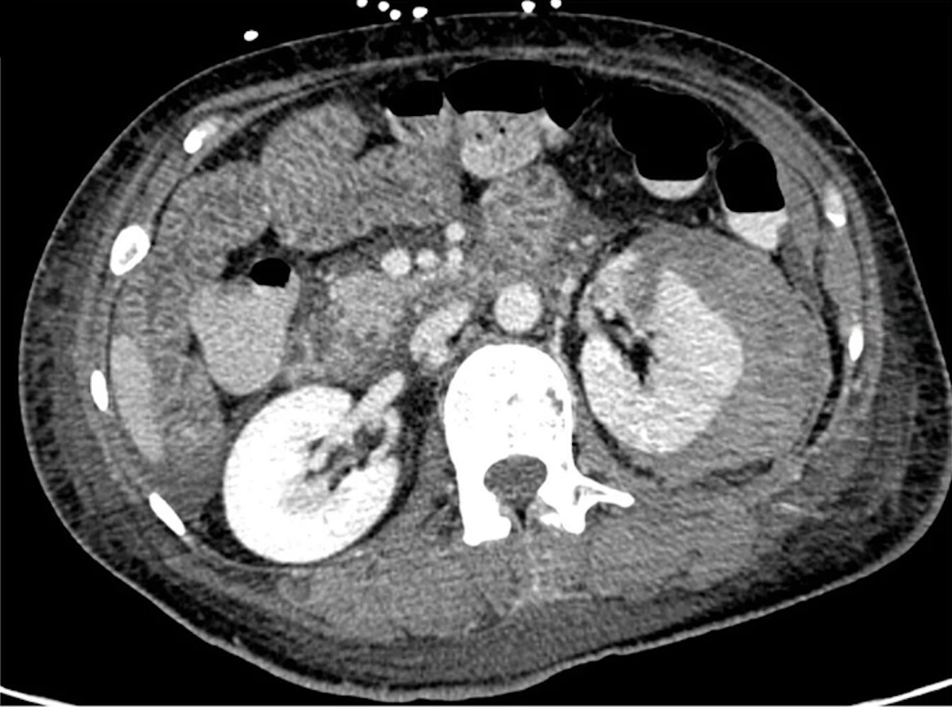 Renal laceration