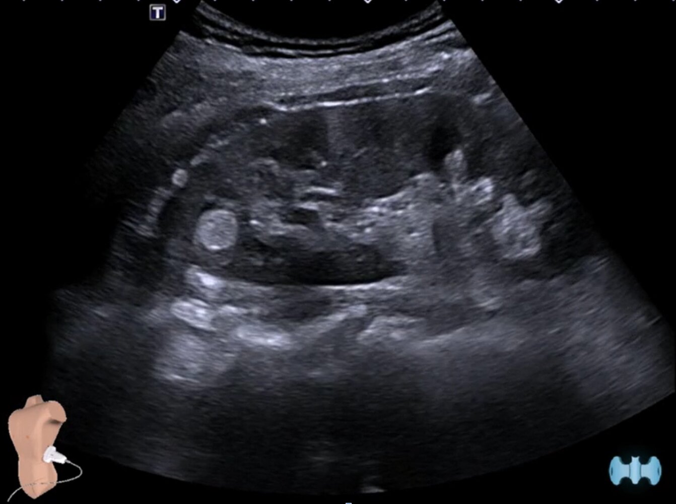 Renal angiomyolipoma