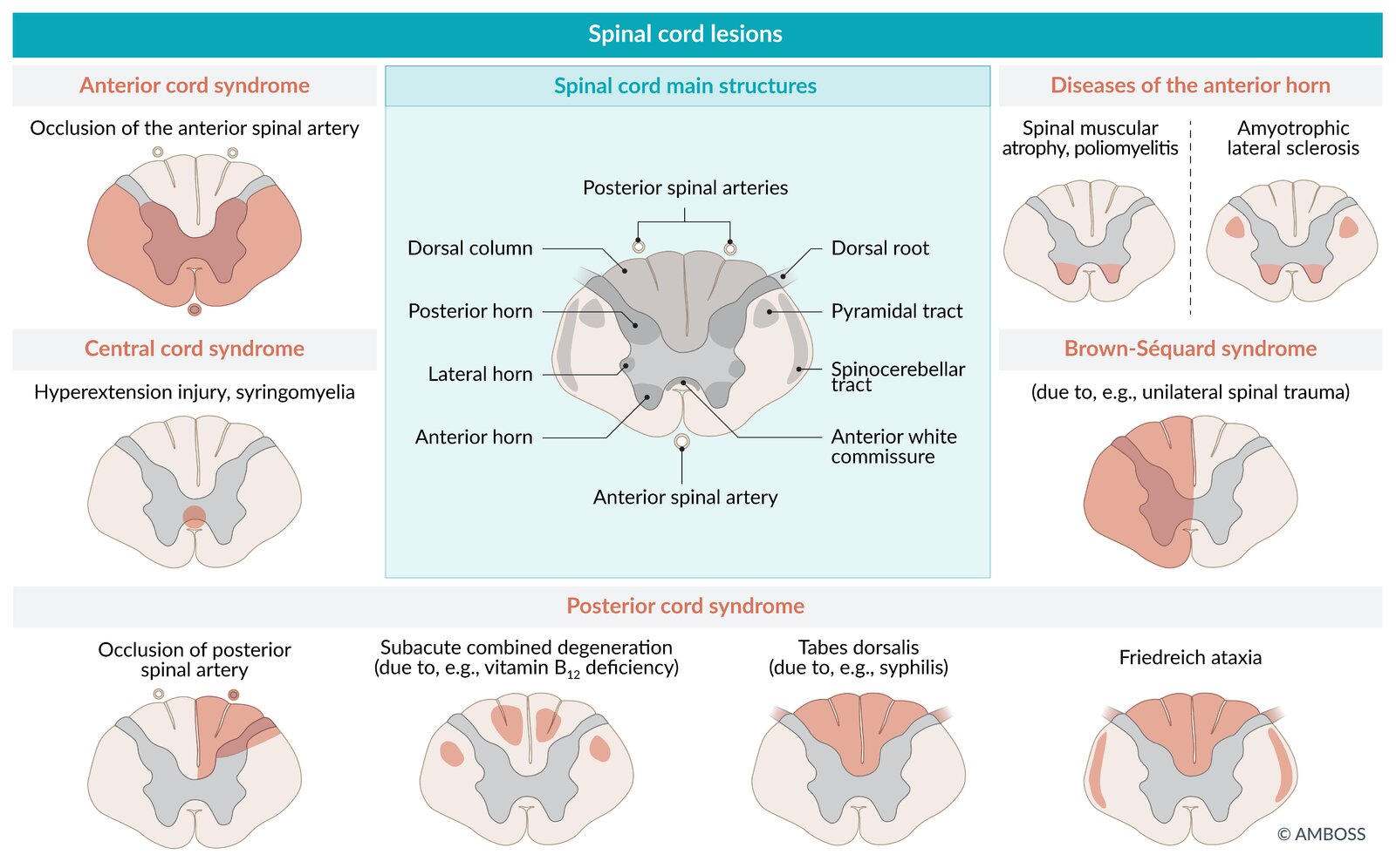 Spinal cord lesions