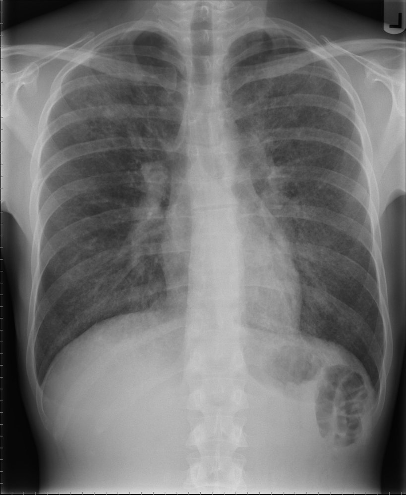 Pneumocystis jiroveci pneumonia (PCP)