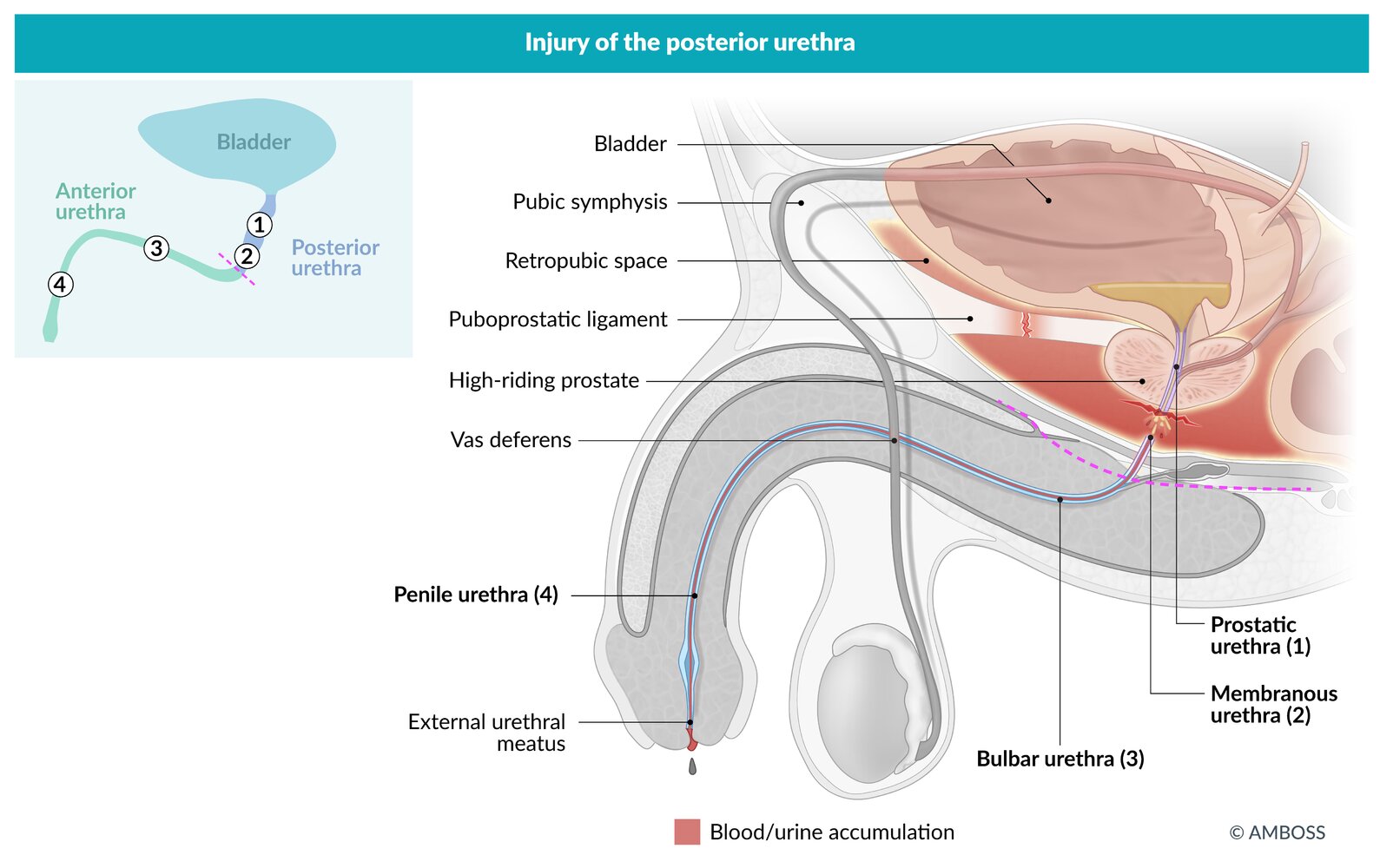 Injury of the posterior urethra