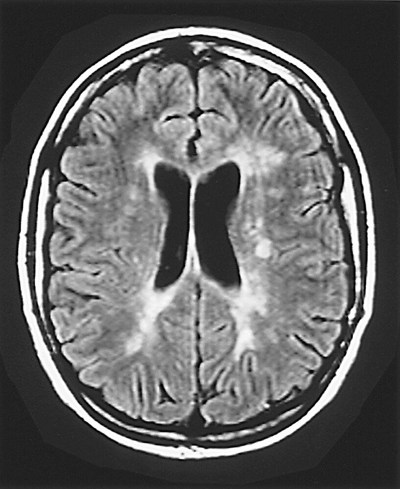 Periventricular signal abnormality