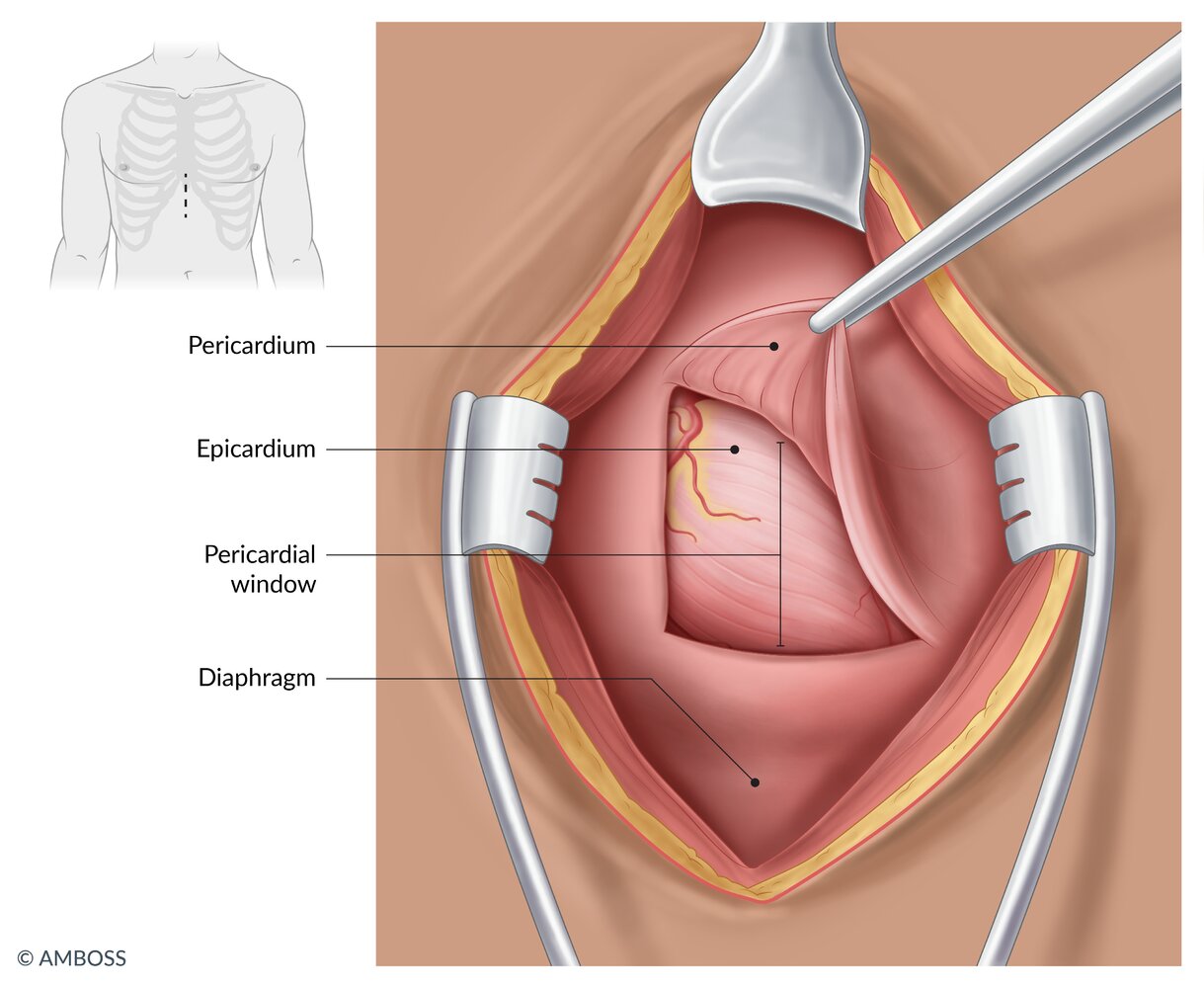 Pericardial window