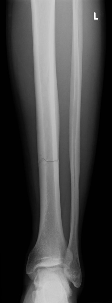 Tibial fracture