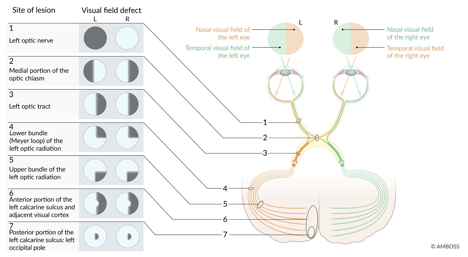 Overview of visual field defects