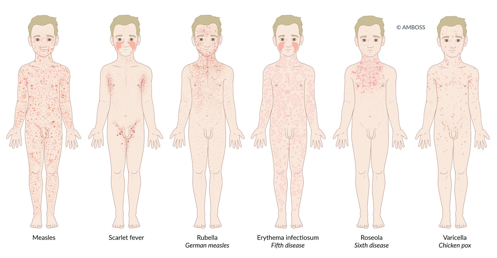 Infectious rashes in children