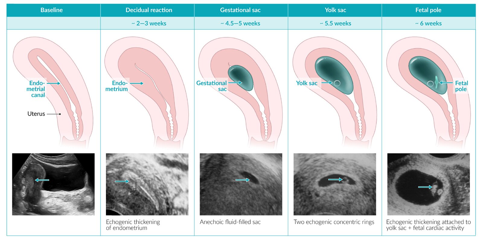 Sonographic features of early intrauterine pregnancy