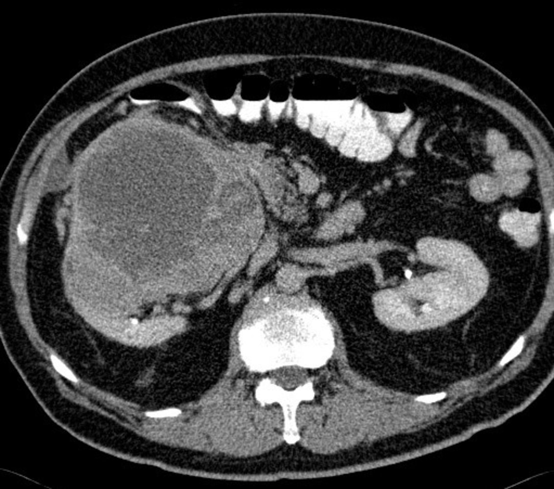 Renal cell carcinoma (2/3)