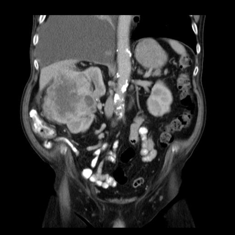 Renal cell carcinoma (3/3)