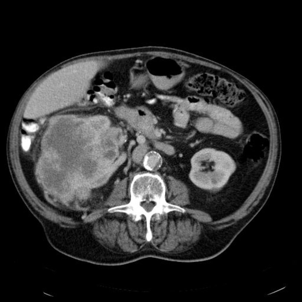 Renal cell carcinoma (1/3)