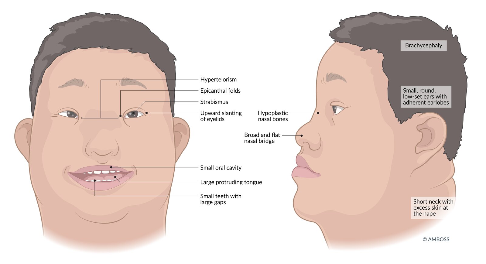 Common facial and cranial features of Down Syndrome