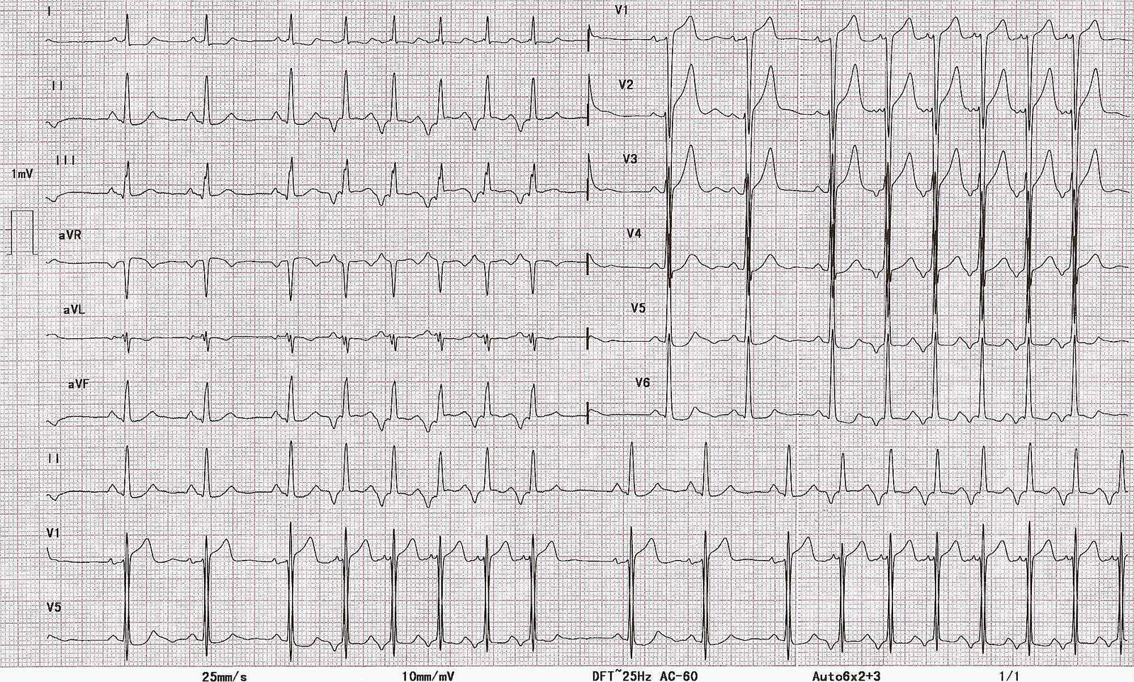 Nonsustained focal atrial tachycardia