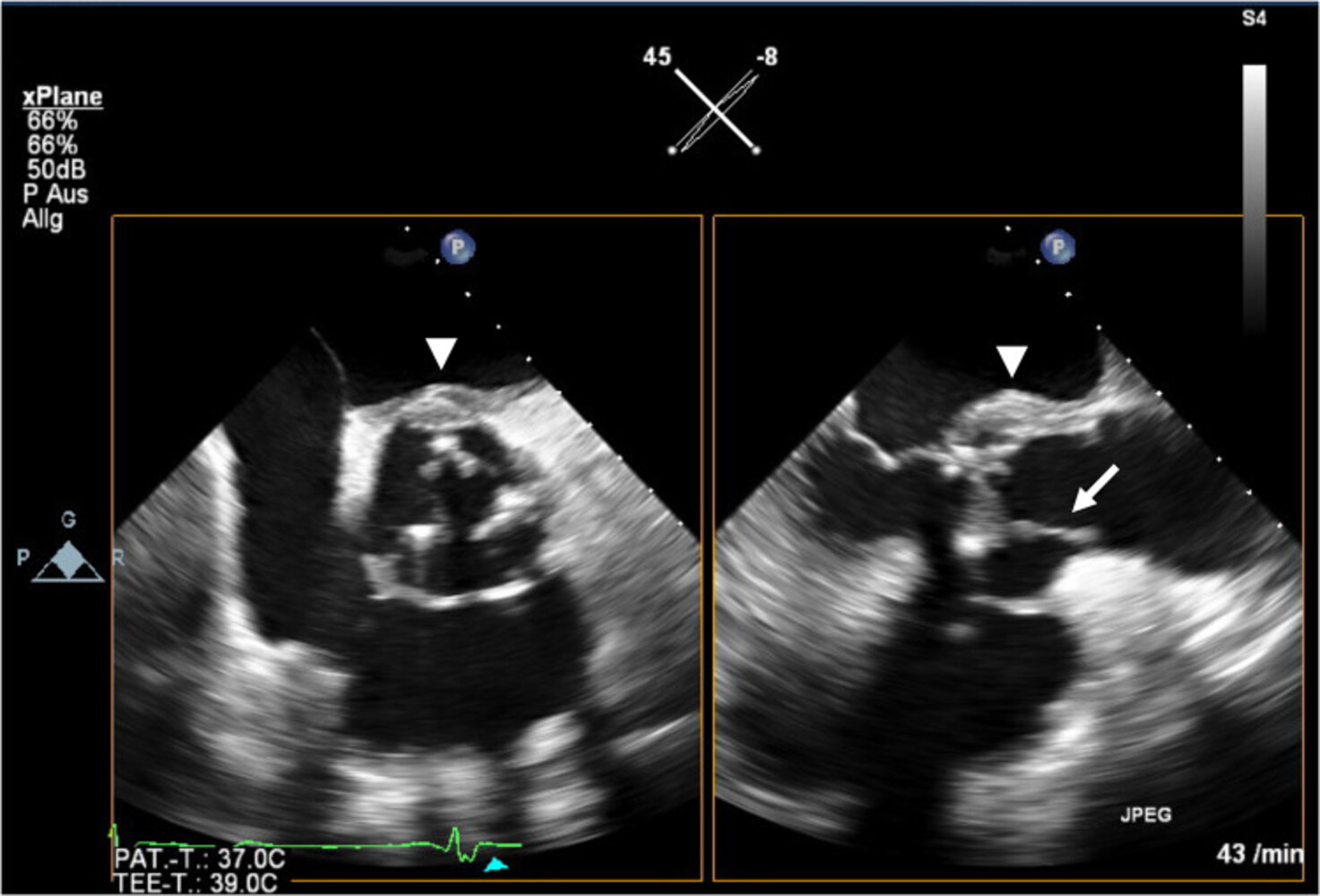 Prosthetic aortic valve with endocarditis and valve ring abscess