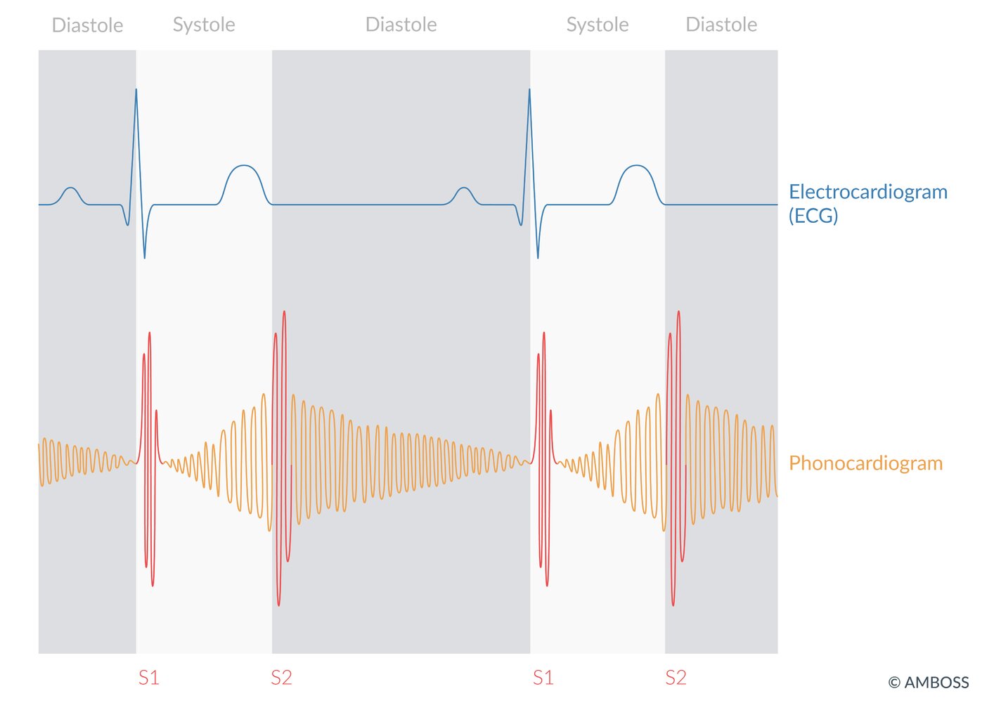 Heart murmur in patent ductus arteriosus