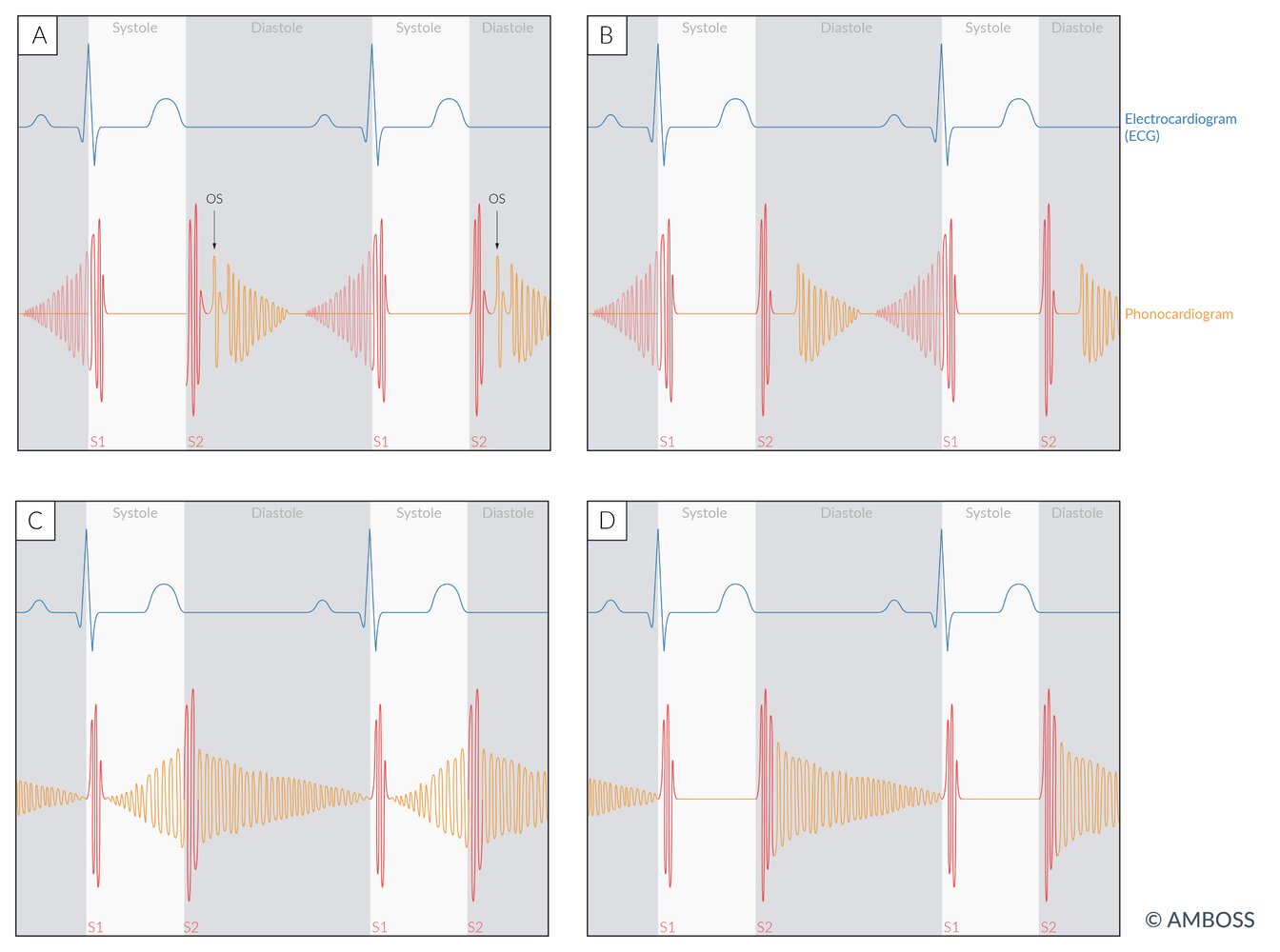 Phonocardiogram of diastolic murmurs