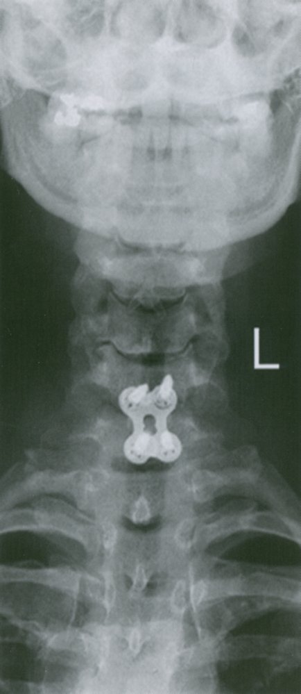 Cervical spondylodesis 1/2