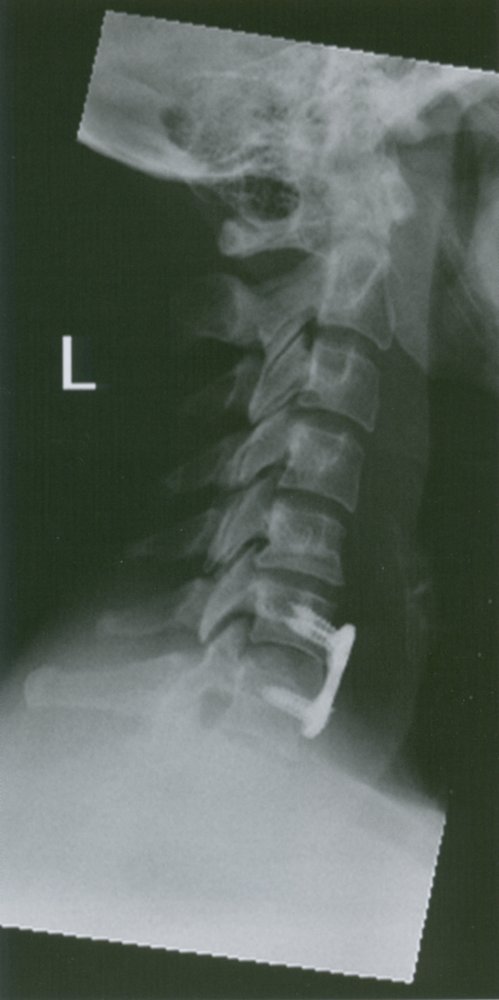 Cervical spondylodesis 2/2
