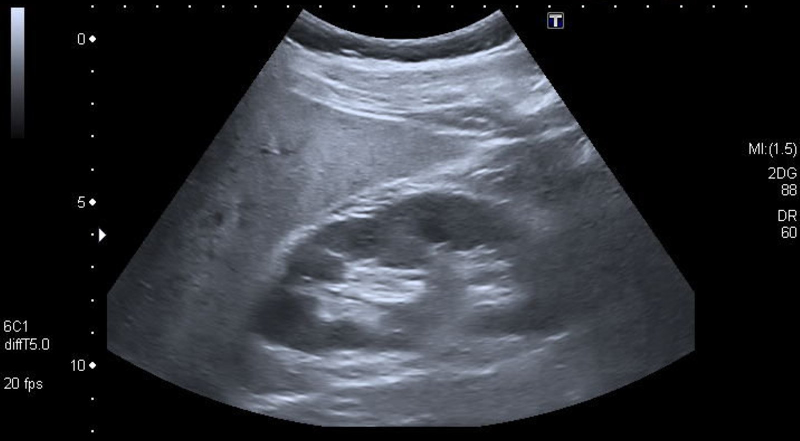 Hepatic steatosis