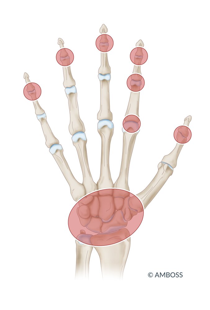 Distribution pattern: Psoriatic arthritis of the hand