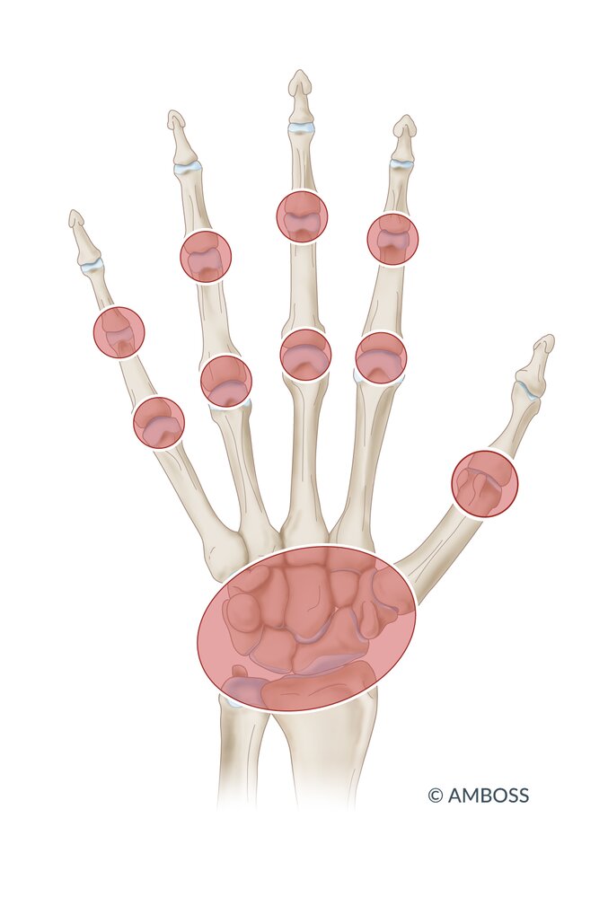 Distribution of joint involvement in rheumatoid arthritis of the hand