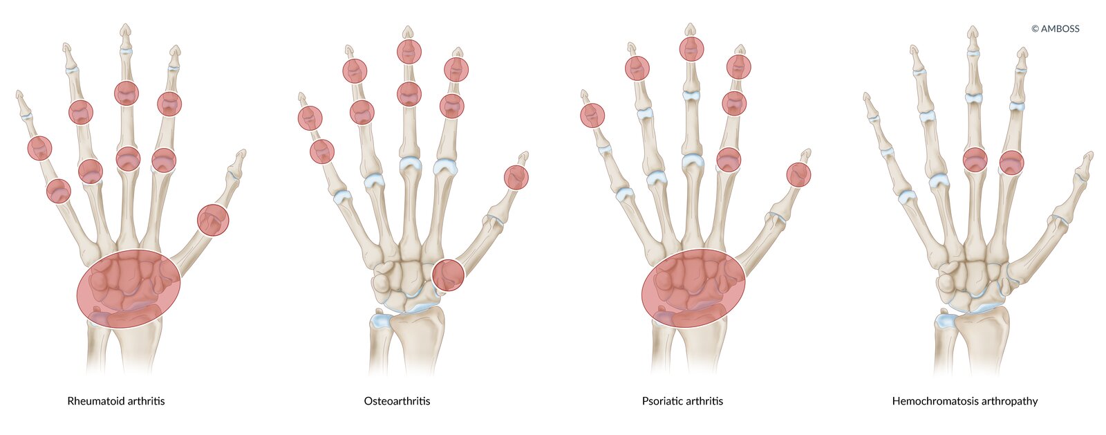 Differential diagnosis: hand joint pain
