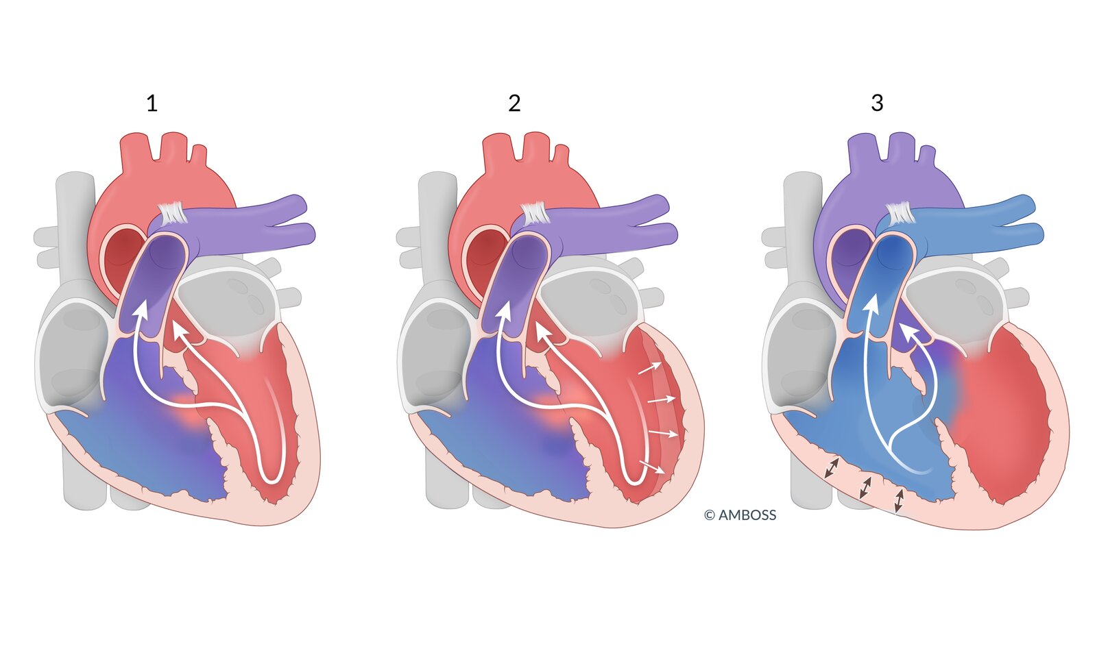 Cardiac hemodynamics in ventricular septal defect