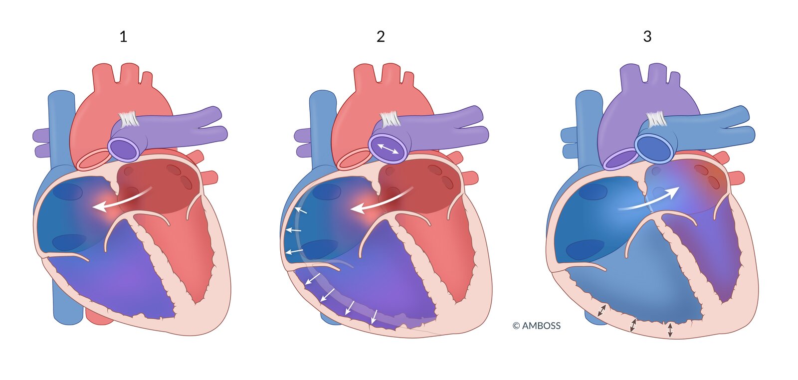 Cardiac hemodynamics in atrial septal defect