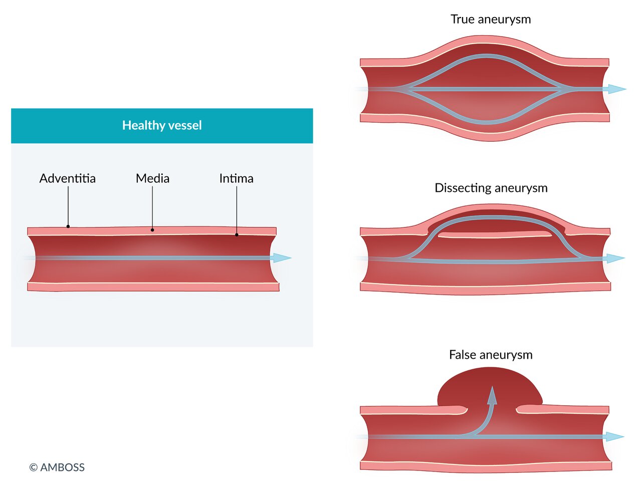 Types of aneurysms